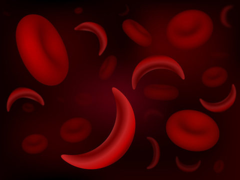 Step Toward Gene Therapy For Sickle Cell Disease 