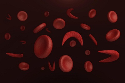 Hydroxyurea Improves Lung Function In Children With Sickle Cell Disease 