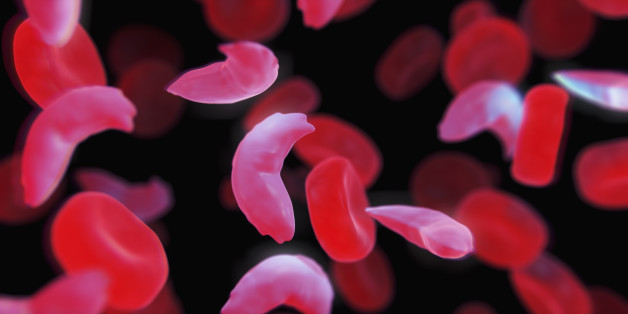 Black Americans With Sickle Cell Trait At Increased Risk Of Kidney Disease 