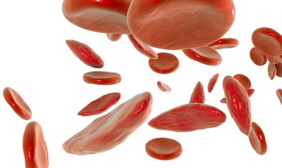 Alzheimer’s Treatment Memantine Shows Promise In Treating Sickle Cell Disease 