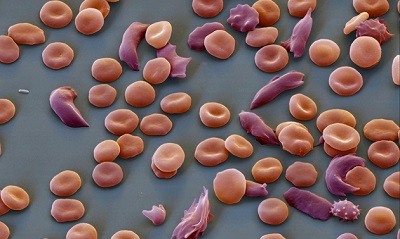 CRISPR Deployed To Combat Sickle-cell Anaemia 