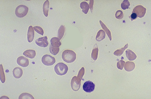 Sickle Cell Anemia On Smear, Microscopic – Hematopathology