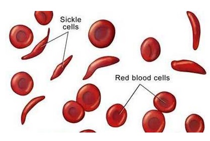 Sickle Cell Foundation Nigeria, Rhieos Develop 1st Multi-SCD Registry In Nigeria 