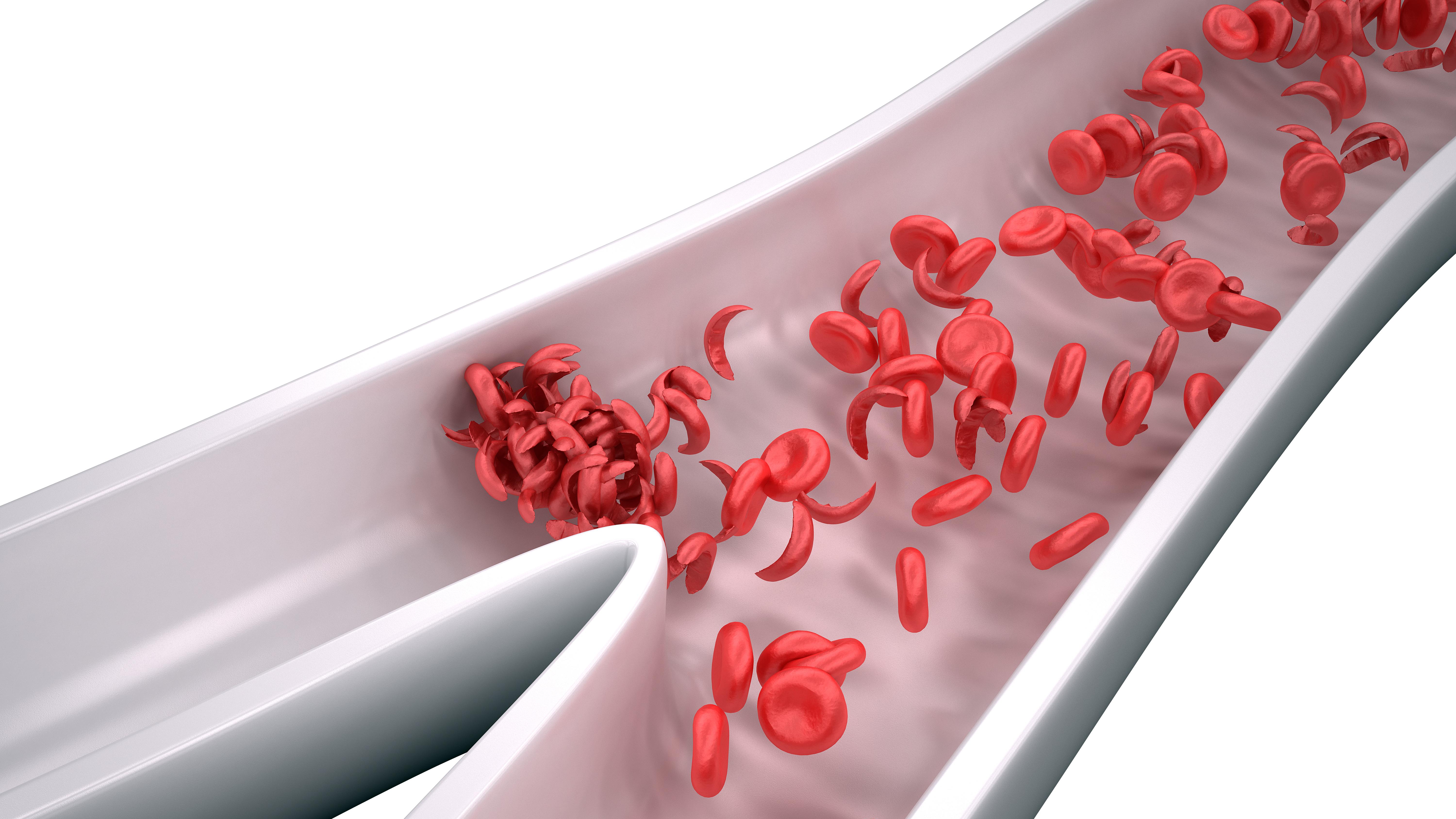 Webinar Series: Sickle Cell Science: Path To Progress – Bone Marrow Transplants, Other Therapies, And Sickle Cell Disease 