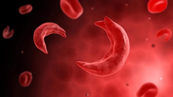 What It’s Like To Live With Sickle-Cell 