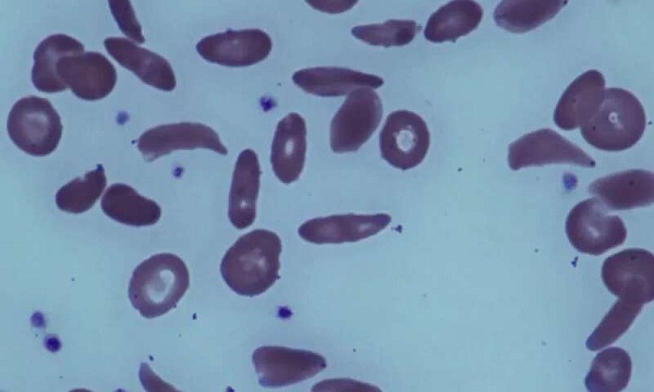 What People With Sickle Cell Disease Need To Know About COVID-19 