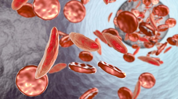 Gut Microbiome Translates Stress Into Sickle Cell Crises 